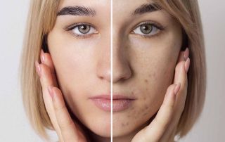 Roaccutane Mental health assessment