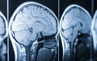 brain injury neuropsychological assessment